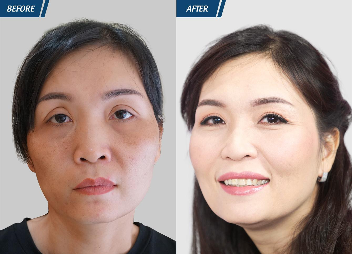 Tin lầm lang băm cắt mí 'chui', người phụ nữ khóc thét vì đôi mắt trợn ngược ảnh 5