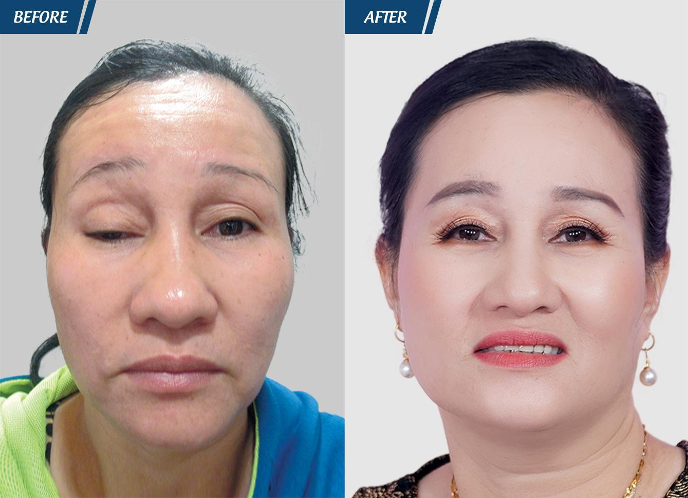 Tin lầm lang băm cắt mí 'chui', người phụ nữ khóc thét vì đôi mắt trợn ngược ảnh 3