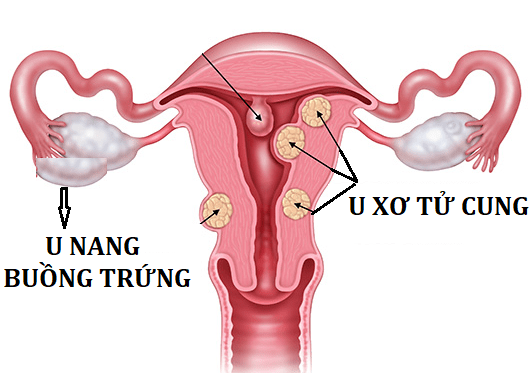 Nga Phụ Khang giúp cải thiện u xơ tử cung, u nang buồng trứng ảnh 1