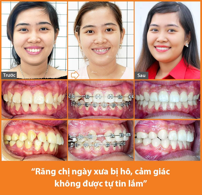Niềng răng đẹp cỡ nào - câu chuyện niềng răng nhiều cảm xúc của cô giáo Như Thắm ảnh 2