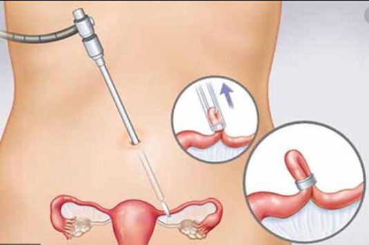 Nga Phụ Khang giúp cải thiện u xơ tử cung, u nang buồng trứng ảnh 2