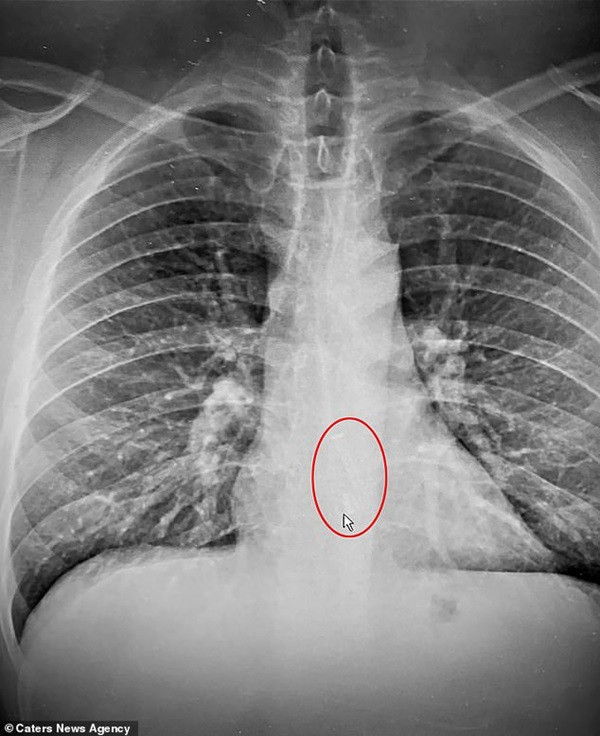 Người đàn ông làm mất Airpods... trong lúc ngủ, khi tới bệnh viện thì biết sự thật bàng hoàng ảnh 2