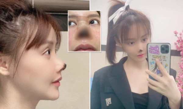 Nữ diễn viên Trung Quốc bị hoại tử đầu mũi sau phẫu thuật thẩm mỹ, lên tiếng cảnh báo mọi người ảnh 4