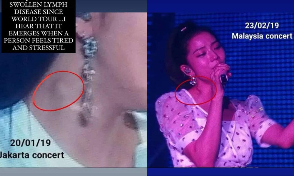 Jisoo (BLACKPINK) nổi hạch lớn ở cổ, bệnh cũ tái phát do phải làm việc đến kiệt sức? ảnh 2