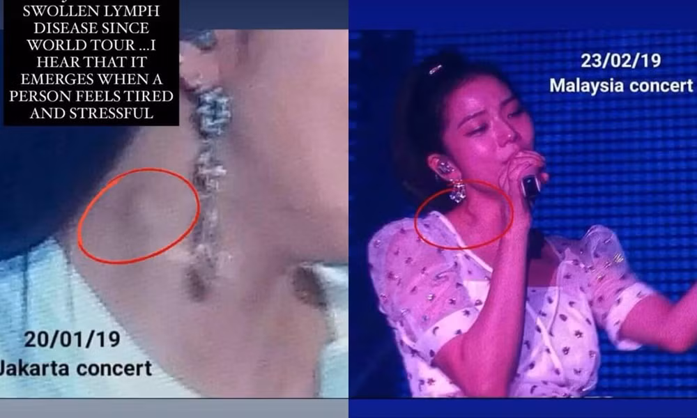 Jisoo (BLACKPINK) nổi hạch lớn ở cổ, bệnh cũ tái phát do phải làm việc đến kiệt sức? ảnh 2