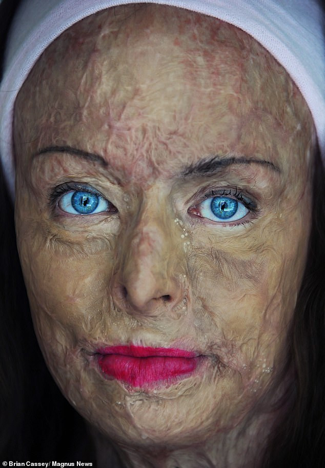 Câu chuyện xúc động sau bức ảnh khoả thân của nữ hoàng sắc đẹp bị bỏng 85% ảnh 5