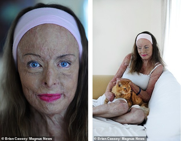 Câu chuyện xúc động sau bức ảnh khoả thân của nữ hoàng sắc đẹp bị bỏng 85% ảnh 3