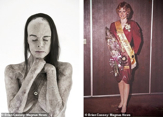 Câu chuyện xúc động sau bức ảnh khoả thân của nữ hoàng sắc đẹp bị bỏng 85% ảnh 2