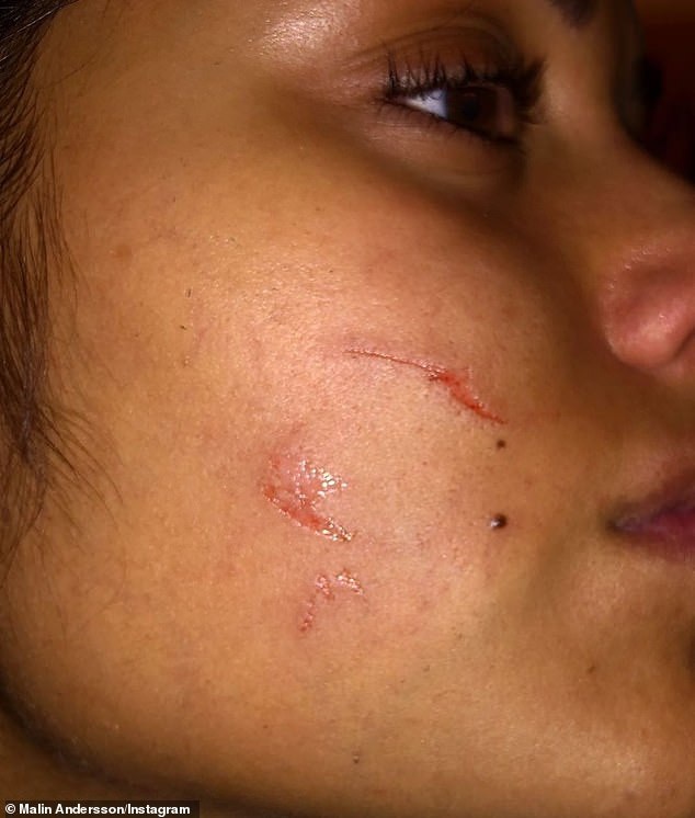 Sao truyền hình Anh bị bạn trai bạo hành đến gãy xương ảnh 4