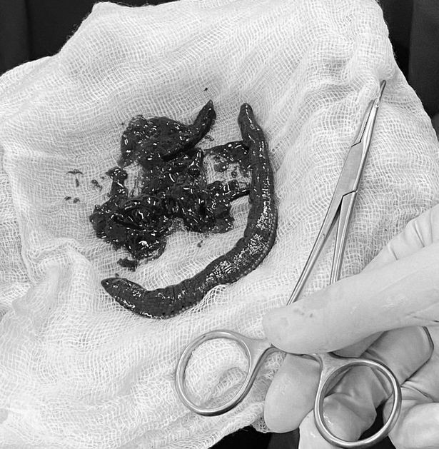 Phát hiện đỉa trong dương vật một người đàn ông, bác sĩ phẫu thuật “chết sững“ ảnh 2