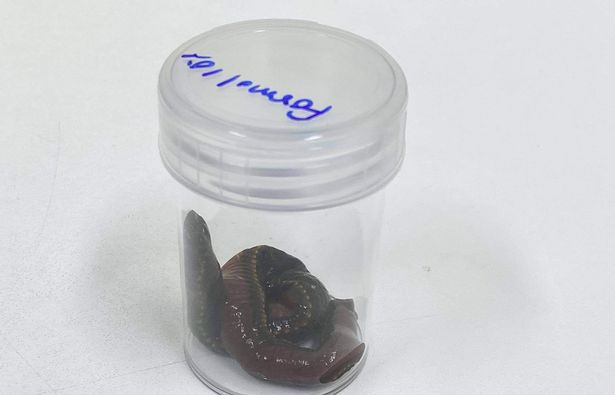 Phát hiện đỉa trong dương vật một người đàn ông, bác sĩ phẫu thuật “chết sững“ ảnh 3