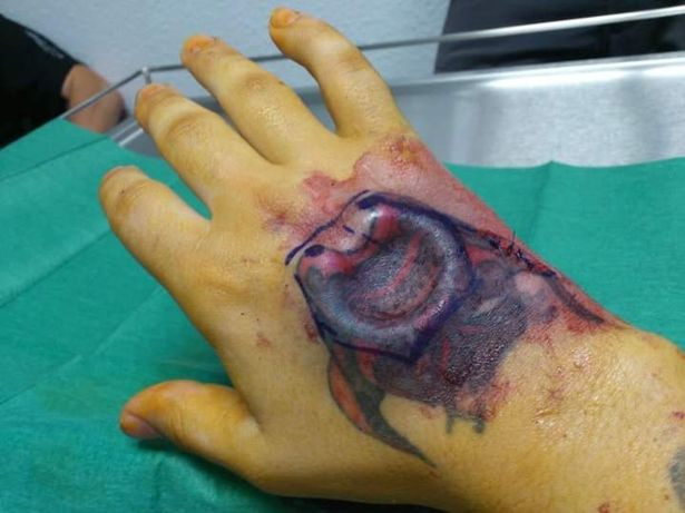 Kinh hãi trước gương mặt của ‘dị nhân’ Đức không tai, phẫu thuật 17 lần cho giống đầu lâu ảnh 5