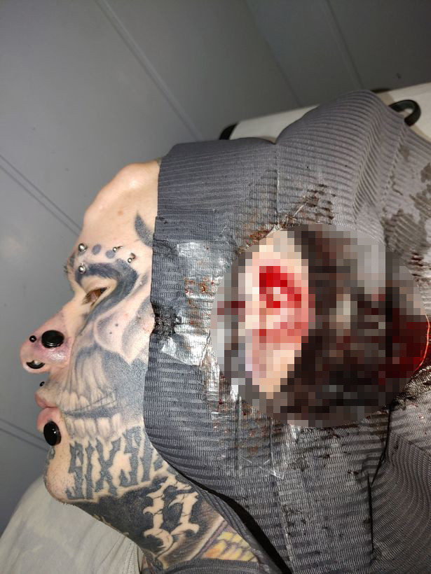 Kinh hãi trước gương mặt của ‘dị nhân’ Đức không tai, phẫu thuật 17 lần cho giống đầu lâu ảnh 2