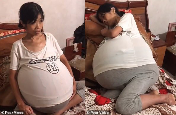 Người phụ nữ gây sốc vì bụng phình khổng lồ suốt 2 năm không rõ nguyên nhân ảnh 5