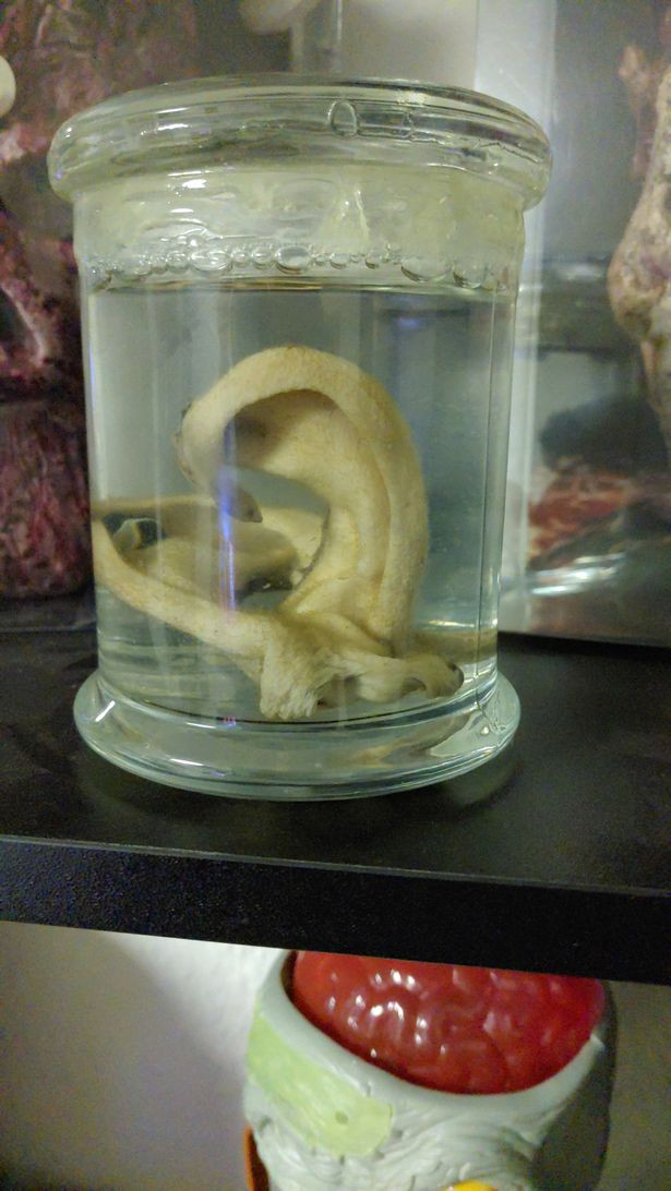 Kinh hãi trước gương mặt của ‘dị nhân’ Đức không tai, phẫu thuật 17 lần cho giống đầu lâu ảnh 4