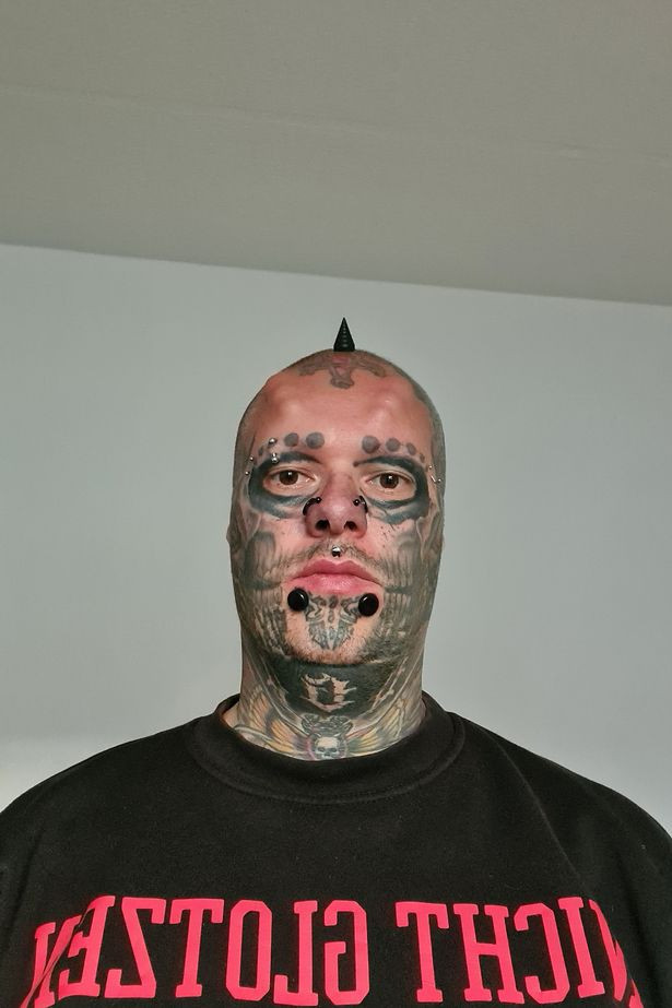 Kinh hãi trước gương mặt của ‘dị nhân’ Đức không tai, phẫu thuật 17 lần cho giống đầu lâu ảnh 1