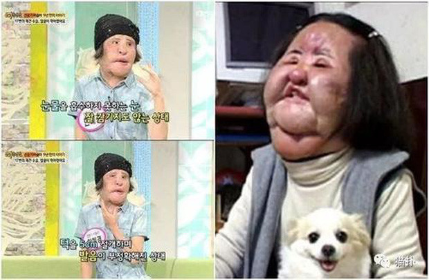  Bi kịch ‘thảm họa thẩm mỹ’ Hàn Quốc: Từ mỹ nhân hóa 'quái vật' ảnh 4