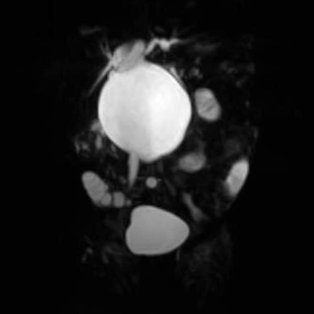 Phẫu thuật nang ống mật ‘to bằng nắm tay’ cho trẻ 2 tháng tuổi bằng… 3 lỗ tí hon ảnh 1