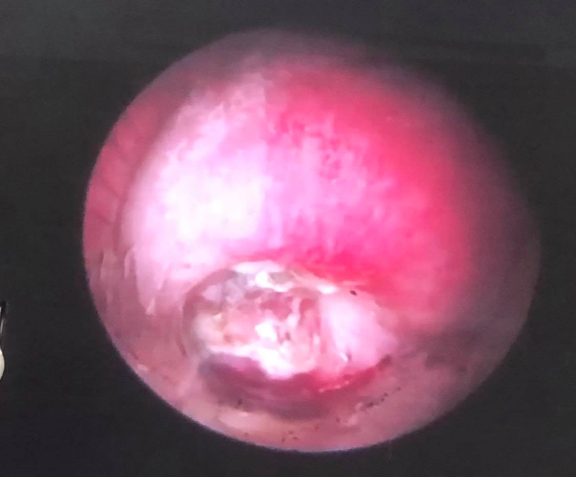 Mảnh xương gà 'dạo chơi' trong đường thở suốt 2 năm ảnh 1