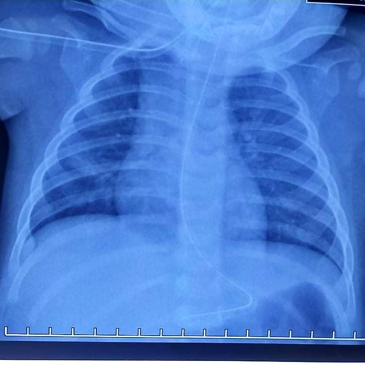 Ăn cháo lươn, bé gái 7 tháng tuổi suýt chết ảnh 2