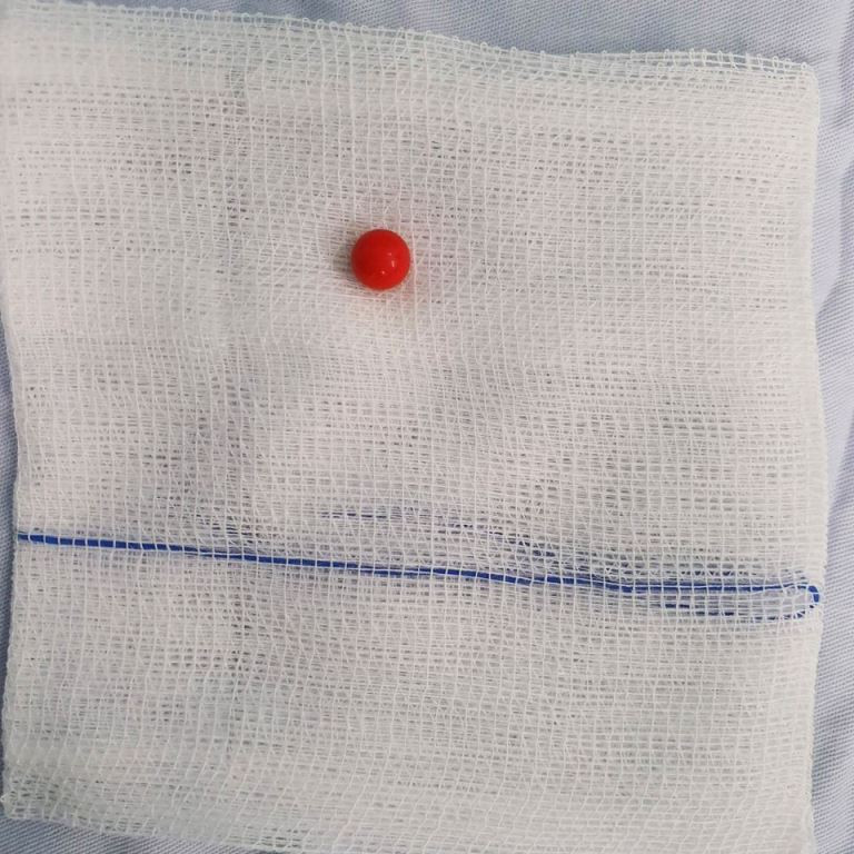 Nghịch dại, bé gái 5 tuổi tự đưa viên bi vào vùng kín ảnh 3