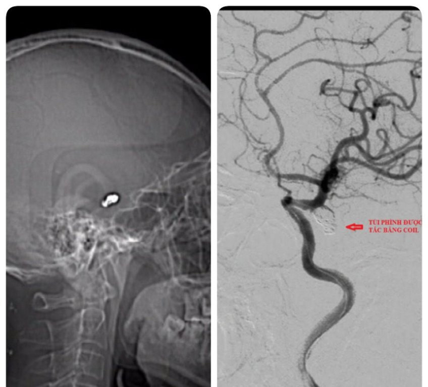 Nút mạch não bằng vòng xoắn kim loại ảnh 1