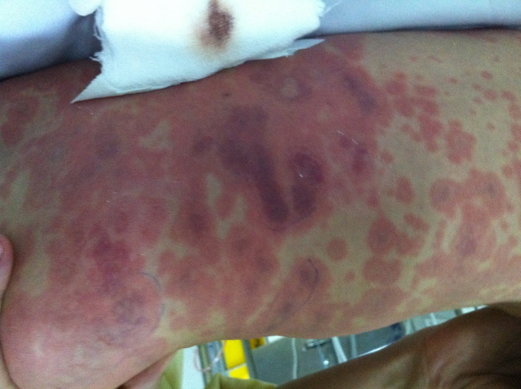 TPHCM: Phát hiện chùm ca bệnh viêm niệu đạo do não mô cầu ảnh 1