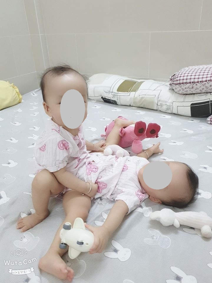 TPHCM: Chuẩn bị tách ca song sinh dính liền 'dùng chung một tã' ảnh 4