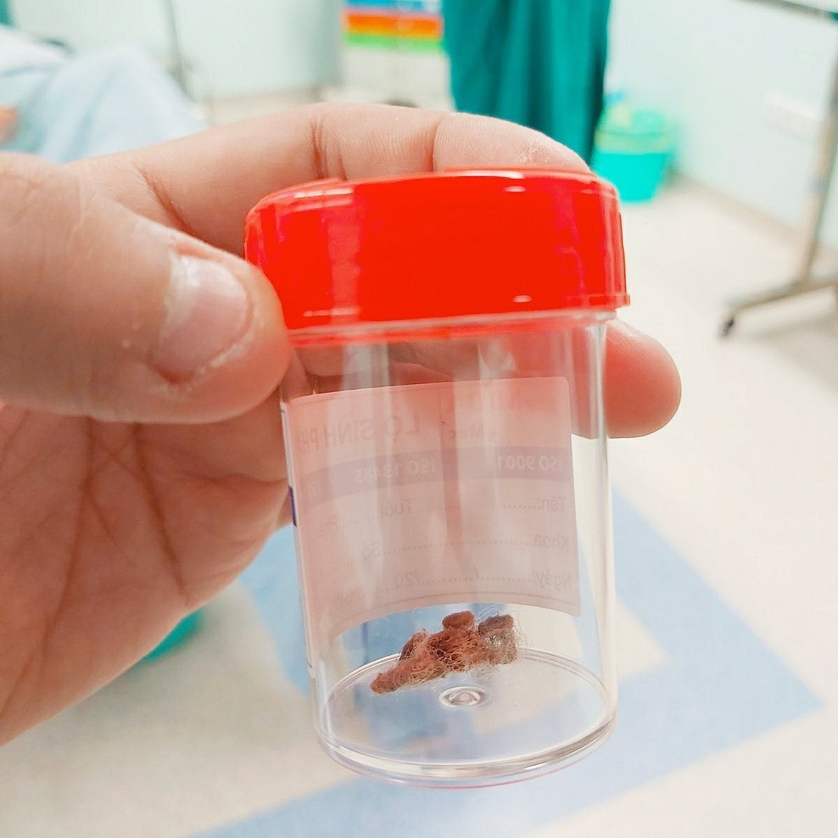 Gắp mảnh bông gòn trong vùng kín của bé gái 6 tuổi ảnh 2