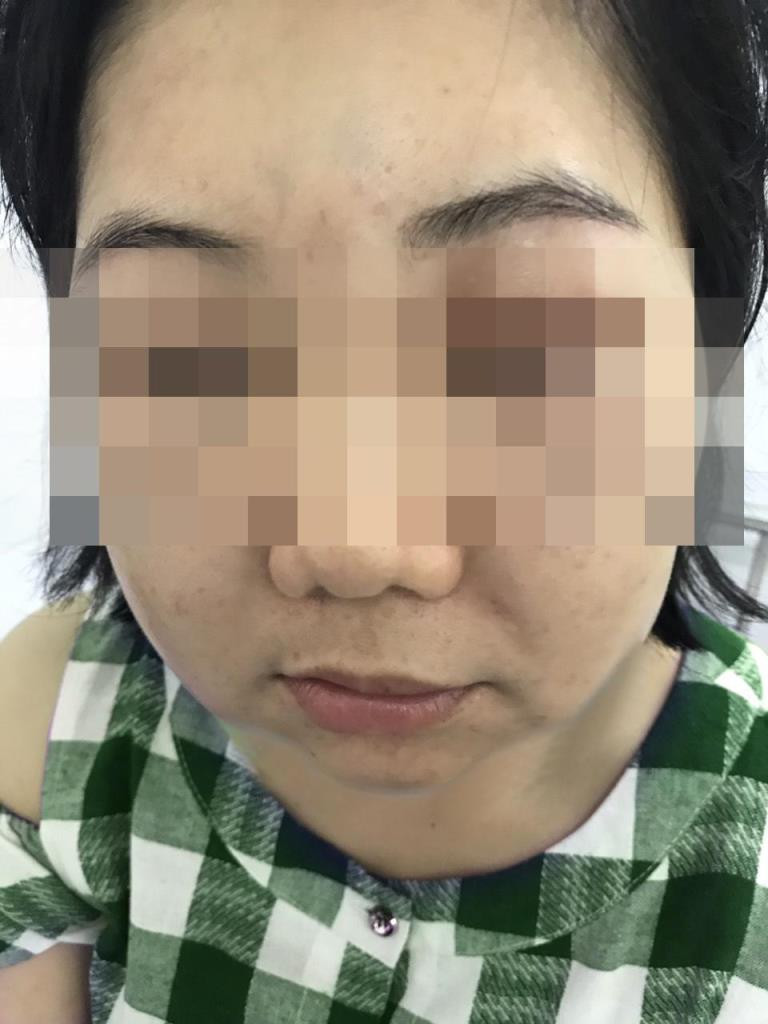 Mặt 'nở hoa' khi tiêm tế bào gốc ảnh 2