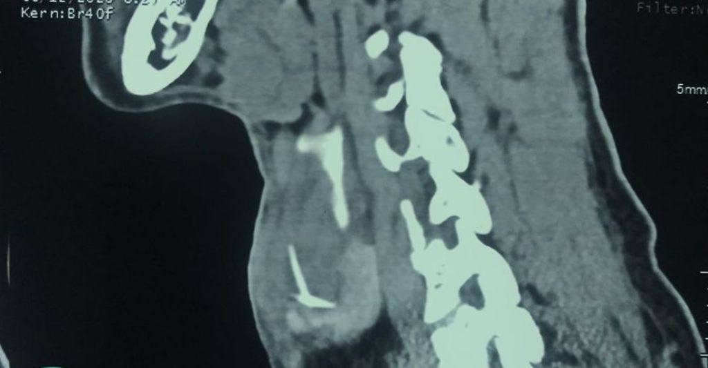Suýt chết vì quên mình đã bị hóc xương cá từ... 4 tháng trước ảnh 1