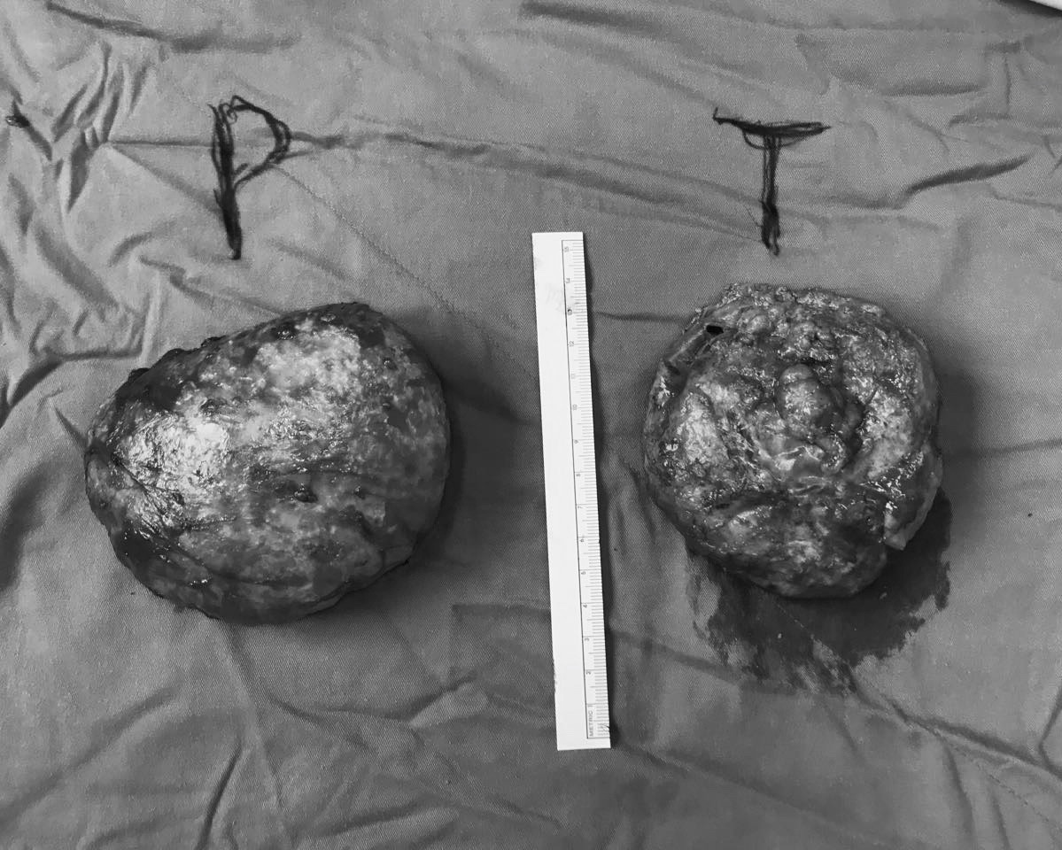 Nâng cấp làm đẹp 'vòng một', người phụ nữ bị vỡ túi ngực ảnh 2