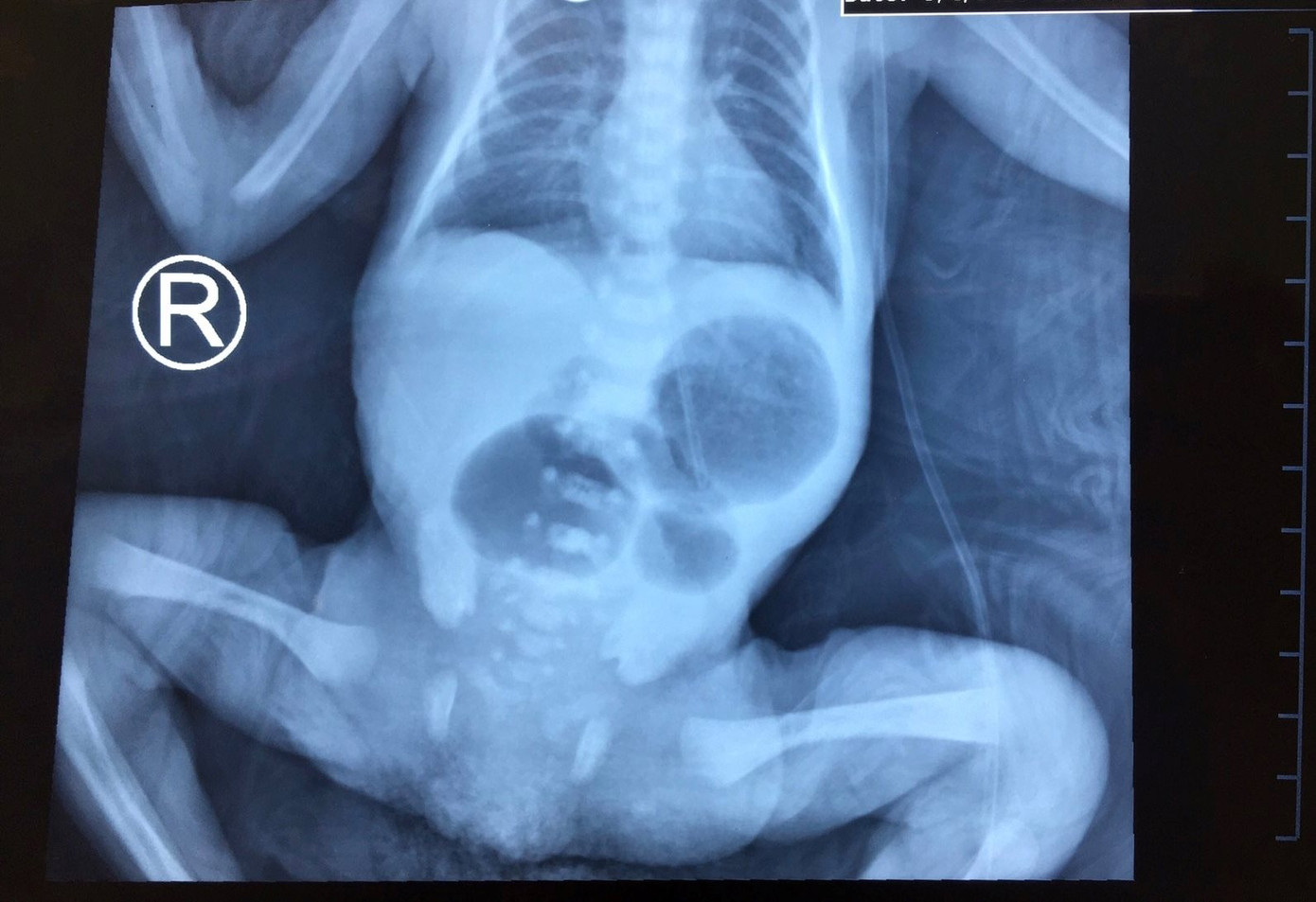 Cứu sống trẻ sinh non bị tắc ruột ​ ảnh 1