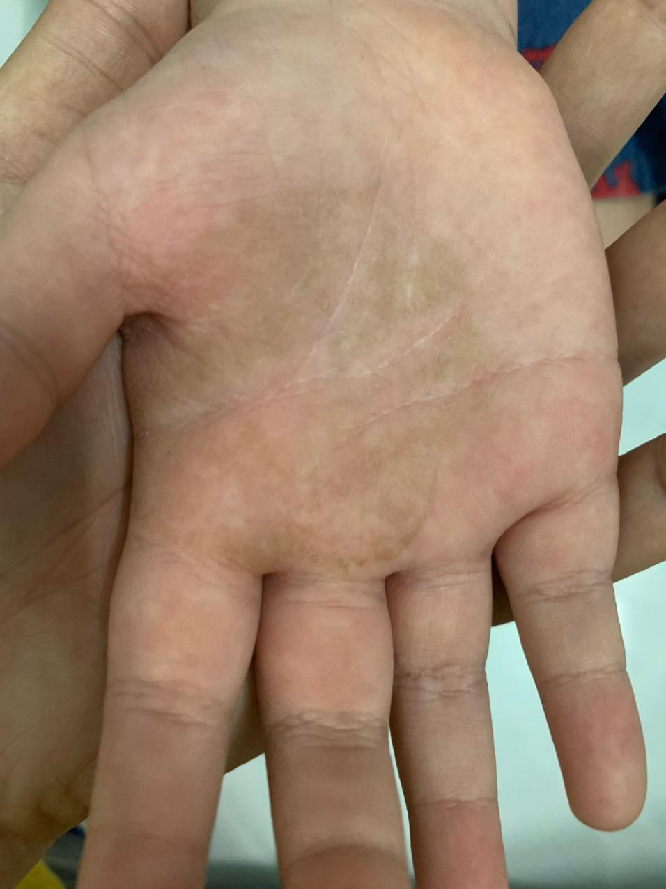 Tưởng con bị bớt sắc tố, đi khám mới biết nhiễm nấm đen ảnh 2