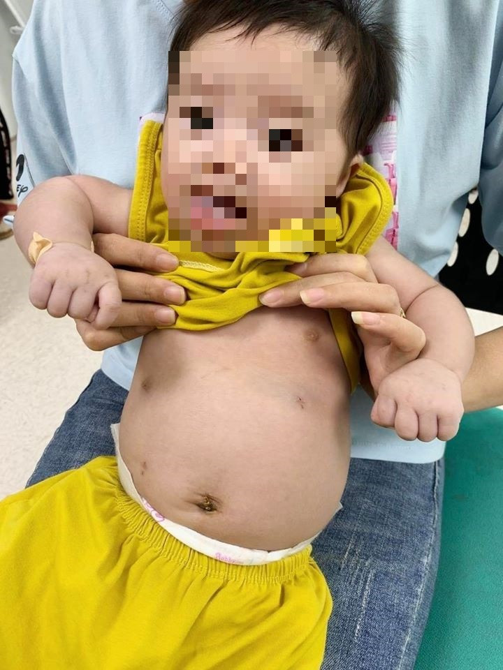 Phẫu thuật nang ống mật ‘to bằng nắm tay’ cho trẻ 2 tháng tuổi bằng… 3 lỗ tí hon ảnh 2