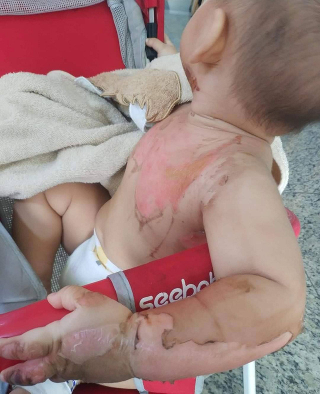 Bị nước sôi đổ lên người, bé trai 2 tuổi bỏng nặng ảnh 2