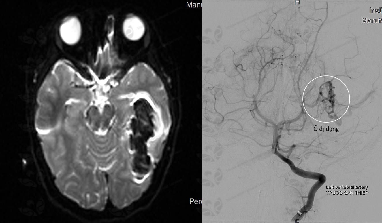 Chớ coi thường đột quỵ ở trẻ em ảnh 1