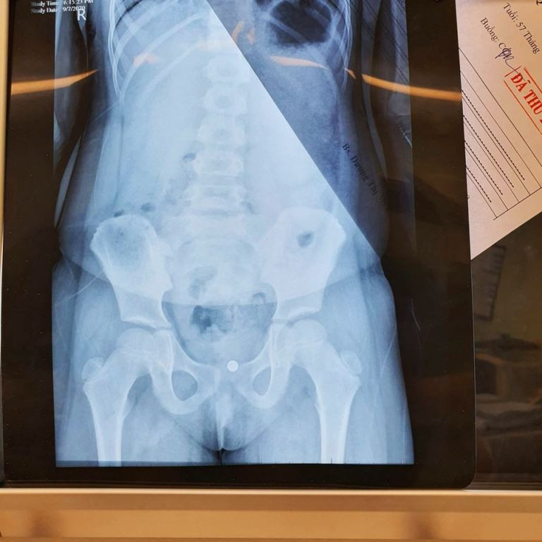 Nghịch dại, bé gái 5 tuổi tự đưa viên bi vào vùng kín ảnh 1