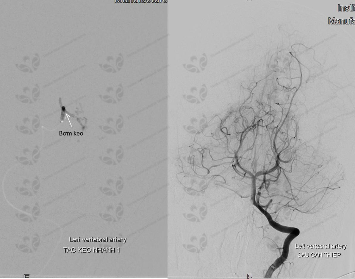 Chớ coi thường đột quỵ ở trẻ em ảnh 2