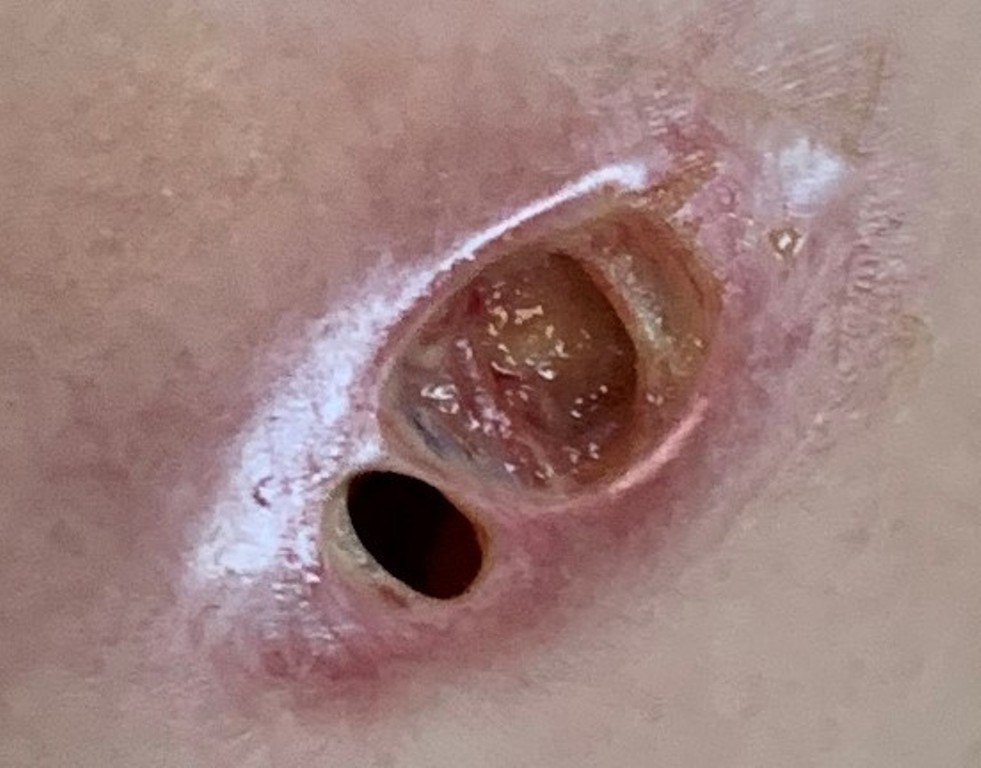 Ngực thủng lỗ sâu hoắm vì tiêm silicon ‘nâng cấp vòng 1’ ảnh 2