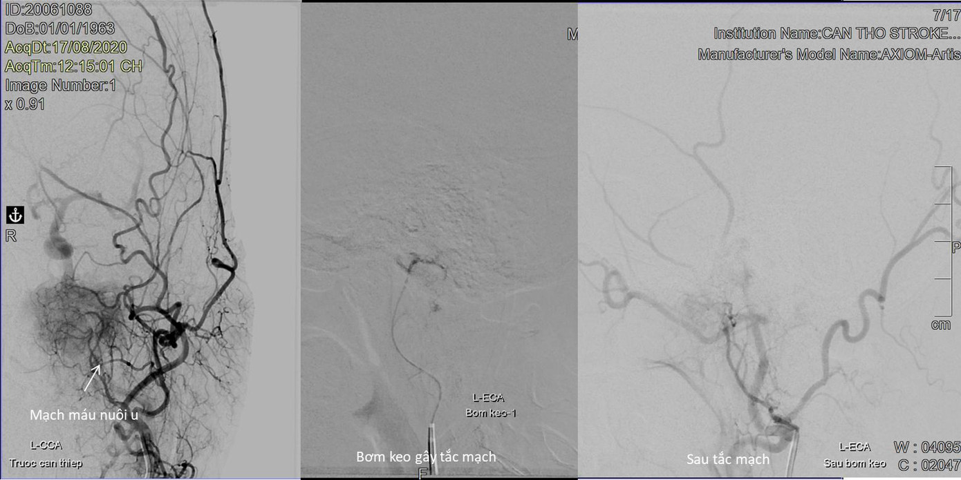 Chóng mặt dài ngày, đi khám mới phat hiện u não hiếm gặp ảnh 1