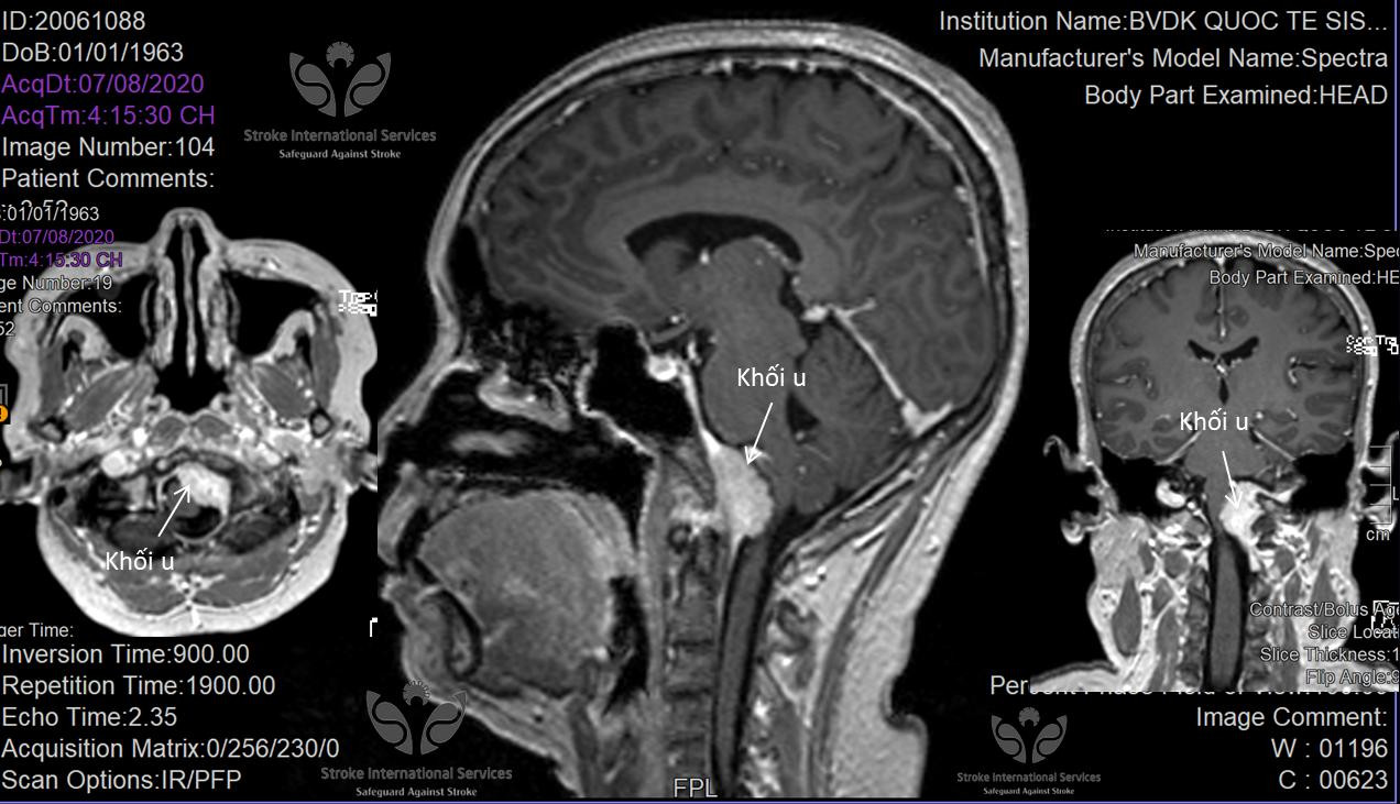 Chóng mặt dài ngày, đi khám mới phat hiện u não hiếm gặp ảnh 2