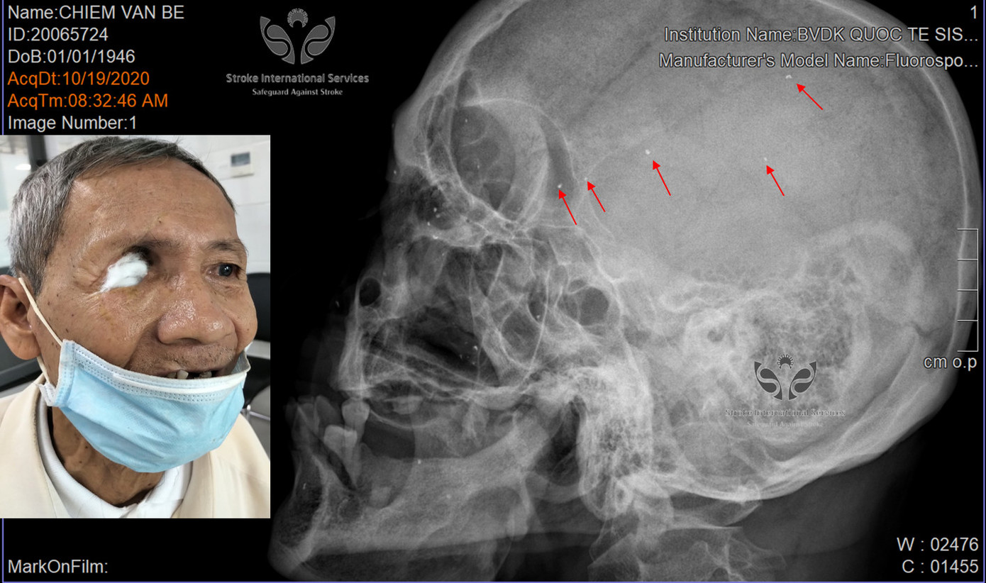 Gắp hàng trăm mảnh đạn trong đầu một thương binh ảnh 2