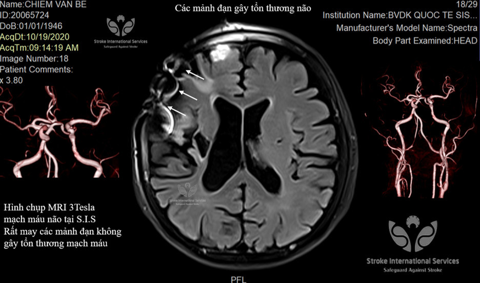 Gắp hàng trăm mảnh đạn trong đầu một thương binh ảnh 1
