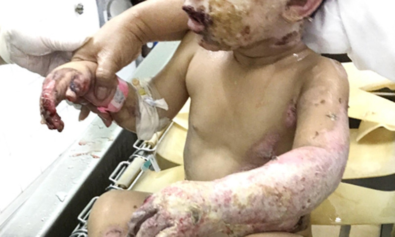 Cứu 2 bé bị bỏng nặng trong vụ ném 'bom xăng' ở Bình Dương ảnh 1