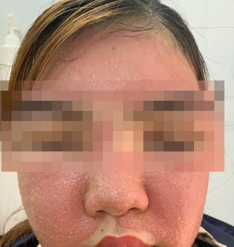 Mặt mũi sưng phù vì đắp mặt nạ làm đẹp da bằng đông y ​ ảnh 1