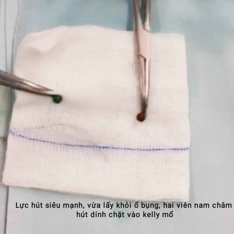 Ruột dính chặt vì hai viên bi nam châm ‘đi lạc’ trong bụng suốt 6 tháng ảnh 1