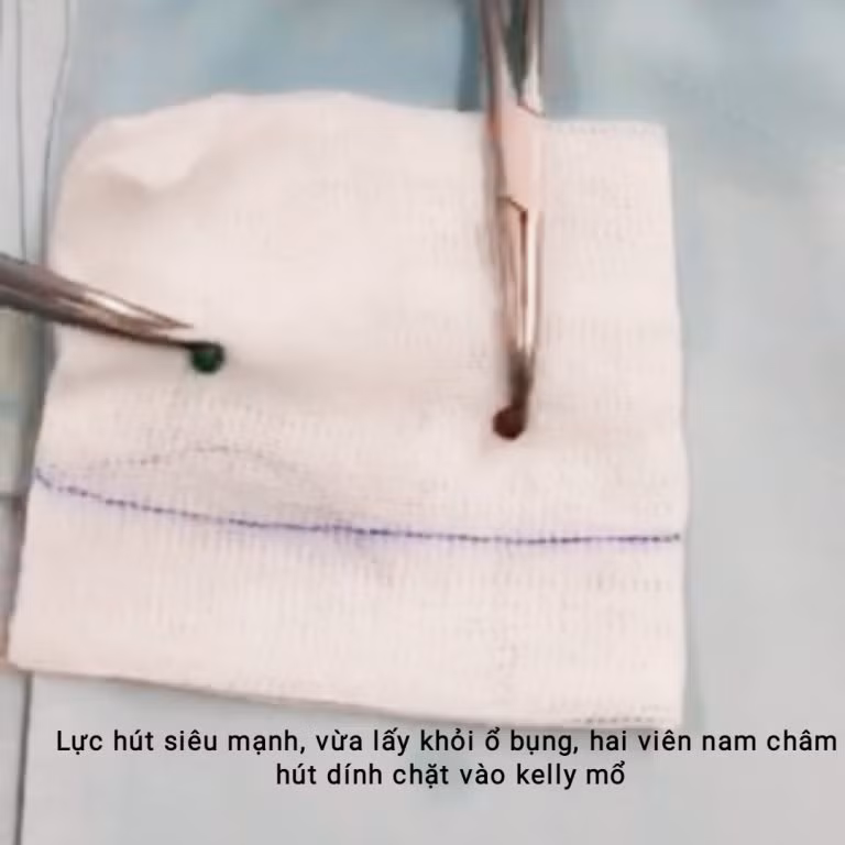 Ruột dính chặt vì hai viên bi nam châm ‘đi lạc’ trong bụng suốt 6 tháng ảnh 1