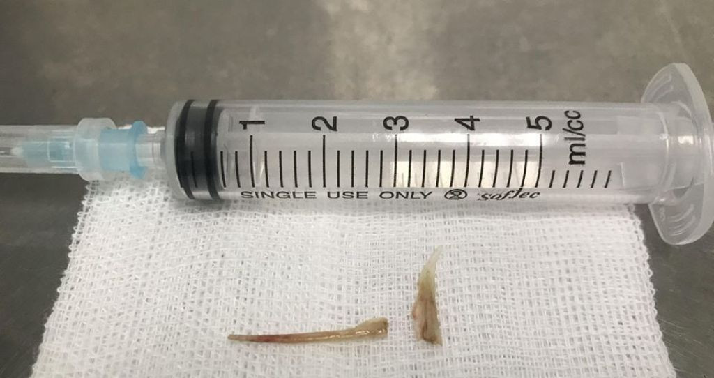 Suýt chết vì quên mình đã bị hóc xương cá từ... 4 tháng trước ảnh 2