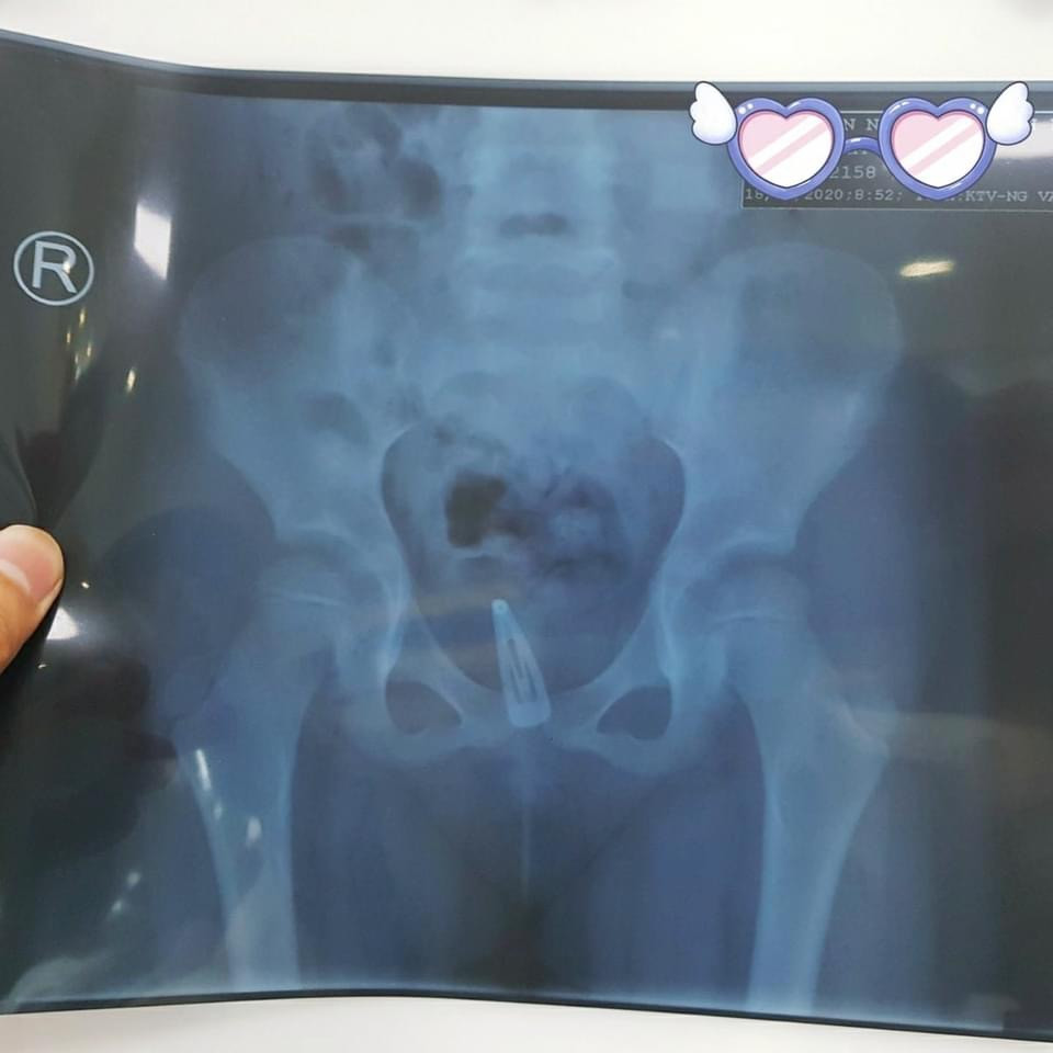 Kẹp tóc mắc kẹt trong cái âm đạo của bé gái suốt 3 tháng ảnh 1